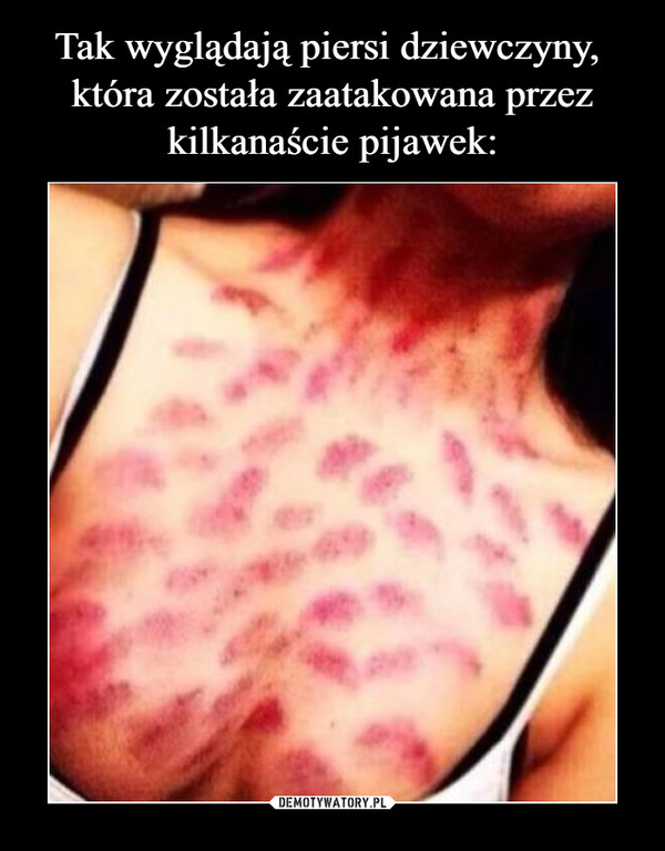 Tak wyglądają piersi dziewczyny, 
która została zaatakowana przez
kilkanaście pijawek: