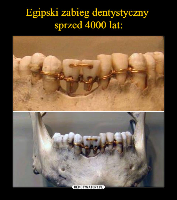 Egipski zabieg dentystyczny 
sprzed 4000 lat: