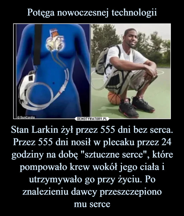 Potęga nowoczesnej technologii Stan Larkin żył przez 555 dni bez serca. Przez 555 dni nosił w plecaku przez 24 godziny na dobę "sztuczne serce", które pompowało krew wokół jego ciała i utrzymywało go przy życiu. Po znalezieniu dawcy przeszczepiono
mu serce